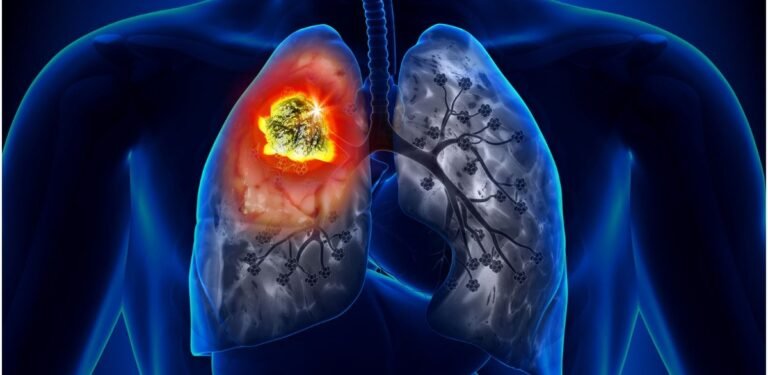 Don’t fall for these common lung cancer misconceptions