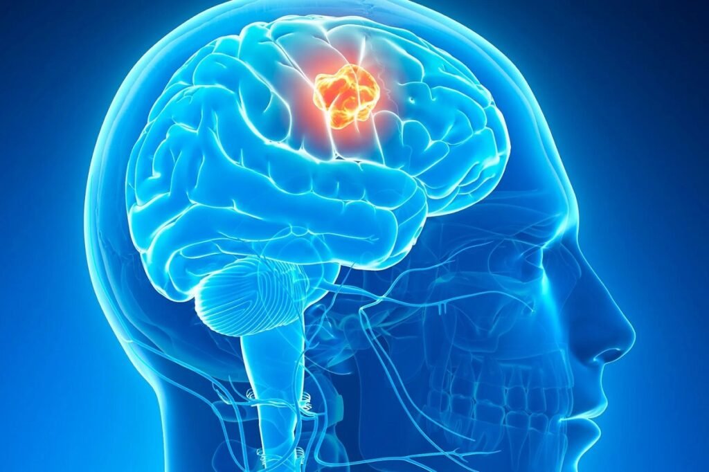 A study suggests that exposure to toxic air may increase the risk of common brain tumors