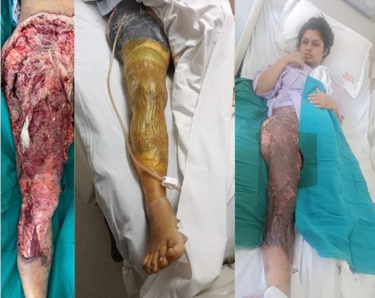 Amrita Hospital announces successful treatment of complex traumacase from Guwahati
